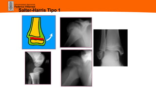 Universidad Nacional
Federico Villarreal
Salter-Harris Tipo 1
 