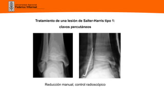 Universidad Nacional
Federico Villarreal
Tratamiento de una lesión de Salter-Harris tipo 1:
clavos percutáneos
Reducción manual, control radioscópico
 