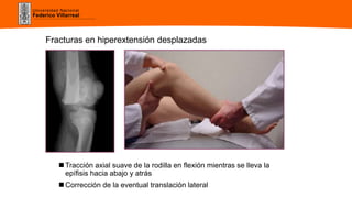 Universidad Nacional
Federico Villarreal
 Tracción axial suave de la rodilla en flexión mientras se lleva la
epífisis hacia abajo y atrás
 Corrección de la eventual translación lateral
Fracturas en hiperextensión desplazadas
 
