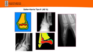 Universidad Nacional
Federico Villarreal
Salter-Harris Tipo II (40 %)
 