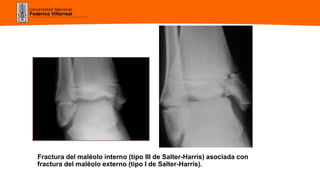 Universidad Nacional
Federico Villarreal
Fractura del maléolo interno (tipo III de Salter-Harris) asociada con
fractura del maléolo externo (tipo I de Salter-Harris).
 