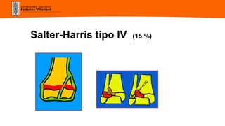 Universidad Nacional
Federico Villarreal
Salter-Harris tipo IV (15 %)
 