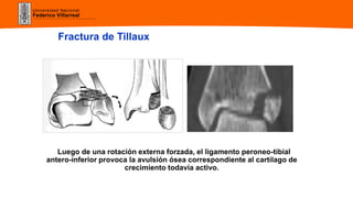Universidad Nacional
Federico Villarreal
Fractura de Tillaux
Luego de una rotación externa forzada, el ligamento peroneo-tibial
antero-inferior provoca la avulsión ósea correspondiente al cartílago de
crecimiento todavía activo.
 