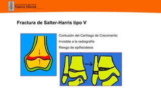 Universidad Nacional
Federico Villarreal
Fractura de Salter-Harris tipo V
Contusión del Cartílago de Crecimiento
Invisible a la radiografía
Riesgo de epifisiodesis
 