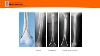 Universidad Nacional
Federico Villarreal
Accidente Posoperatorio Antes de extraer los clavos
 