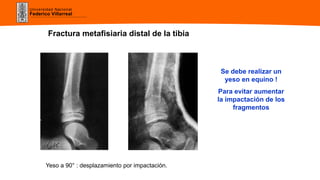 Universidad Nacional
Federico Villarreal
Fractura metafisiaria distal de la tibia
Se debe realizar un
yeso en equino !
Para evitar aumentar
la impactación de los
fragmentos
Yeso a 90° : desplazamiento por impactación.
 
