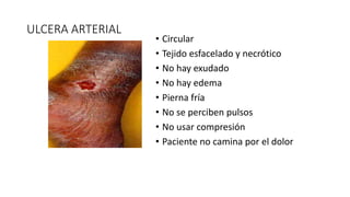 ULCERA ARTERIAL
• Circular
• Tejido esfacelado y necrótico
• No hay exudado
• No hay edema
• Pierna fría
• No se perciben pulsos
• No usar compresión
• Paciente no camina por el dolor
 