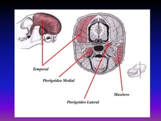Temporal
Pterigoideo Medial

Masétero
Pterigoideo Lateral

 