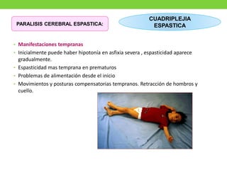 • Manifestaciones tempranas
• Inicialmente puede haber hipotonía en asfixia severa , espasticidad aparece
gradualmente.
• Espasticidad mas temprana en prematuros
• Problemas de alimentación desde el inicio
• Movimientos y posturas compensatorias tempranos. Retracción de hombros y
cuello.
CUADRIPLEJIA
ESPASTICA
PARALISIS CEREBRAL ESPASTICA:
 