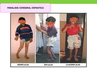 PARALISIS CEREBRAL ESPASTICA
 