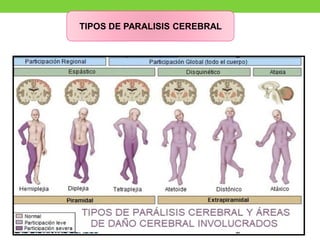TIPOS DE PARALISIS CEREBRAL
 