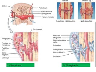 1.- Hematoma 2.- Fibrogénesis
 