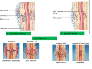 3.- osificación Inicial
4.- Callo óseo
5.- Remodelación
 