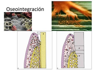 Oseointegración
 