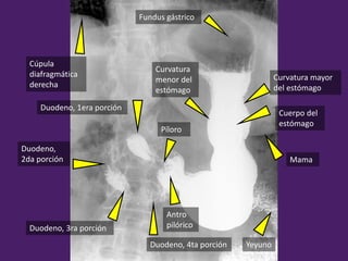 Mama
Cúpula
diafragmática
derecha
Yeyuno
Curvatura mayor
del estómago
Cuerpo del
estómago
Fundus gástrico
Curvatura
menor del
estómago
Píloro
Antro
pilórico
Duodeno, 1era porción
Duodeno,
2da porción
Duodeno, 4ta porción
Duodeno, 3ra porción
 