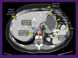Aorta
descendente
Vena cava
inferior
Lóbulo
derecho
del hígado
Recto del
abdomen
Fundus
gástrico
Bazo
Arteria
esplénica
Vena esplénica
Lóbulo
izquierdo
del hígado
Pilares del
diafragma
 