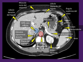 Músculo
recto del
abdomen
Lóbulo
izquierdo del
hígado Ángulo
esplénico del
colon
Bazo
Riñón
izquierdo
Páncreas
Arteria esplénica
Aorta
descendente
Vena cava
inferior
Lóbulo
derecho
del hígado
Fundus
gástrico
Pilares del
diafragma
Colon
descendente
Glándula
suprarrenal
derecha
 