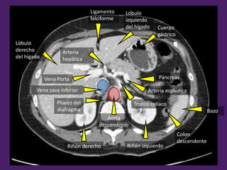 Cuerpo
gástrico
Colon
descendente
Arteria esplénica
Arteria
hepática
Tronco celíaco
Ligamento
falciforme
Vena Porta
Bazo
Aorta
descendente
Vena cava inferior
Pilares del
diafragma
Lóbulo
izquierdo
del hígado
Lóbulo
derecho
del hígado
Riñón derecho Riñón izquierdo
Páncreas
 