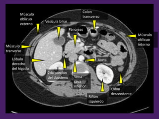 Colon
descendente
Músculo
oblicuo
interno
Músculo
oblicuo
externo
Músculo
tranverso
Vesícula biliar
Páncreas
Colon
transverso
Aorta
2da porción
del duodeno
Riñón
izquierdo
Lóbulo
derecho
del hígado
Vena
cava
inferior
 