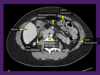 3ra porción
del duodeno
Vena mesentérica
superior
Colon
transverso
Colon
descendente
Asas
yeyunoileales
Hígado
 