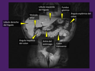 Ángulo esplénico del
colon
Ángulo hepático
del colon Colon
transverso
Lóbulo derecho
del hígado
Lóbulo izquierdo
del hígado
Fundus
gástrico
Vesícula
biliar
Antro del
estómago
 