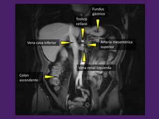 Vena renal Izquierda
Arteria mesentérica
superior
Tronco
celíaco
Vena cava Inferior
Colon
ascendente
Fundus
gástrico
 
