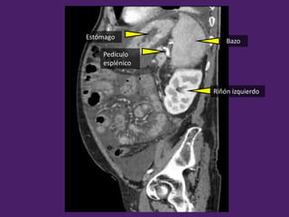 Bazo
Estómago
Pedículo
esplénico
Riñón izquierdo
 