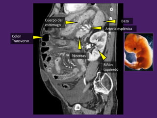 Riñón
izquierdo
BazoCuerpo del
estómago
Páncreas
Arteria esplénica
Colon
Transverso
 