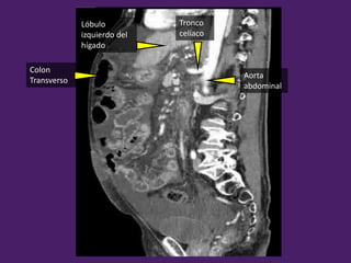 Tronco
celíaco
Lóbulo
izquierdo del
hígado
Colon
Transverso
Aorta
abdominal
 