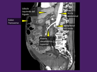 Arteria
mesentérica
superior
Vena Renal
izquierda
Aorta
abdominal
Lóbulo
izquierdo del
hígado
Colon
Transverso
 