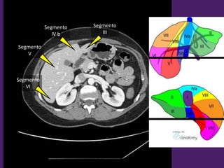 L1-L2
Segmento
III
Segmento
IV b
Segmento
V
Segmento
VI
 