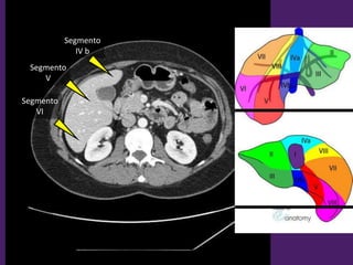 L2
Segmento
IV b
Segmento
VI
Segmento
V
 