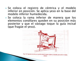  Se coloca el registro de céntrica y el modelo
inferior en posición. Se aplica yeso en la base del
modelo inferior humedecida.
 Se coloca la rama inferior de manera que los
elementos condilares queden en su posición más
posterior y que el vástago toque la guía incisal
(que fragüe el yeso).
 