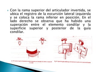  Con la rama superior del articulador invertida, se
ubica el registro de la excursión lateral izquierda
y se coloca la rama inferior en posición. En el
lado derecho se observa que ha habido una
superación entre el elemento condilar y la
superficie superior y posterior de la guía
condilar.
 