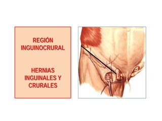 REGIÓN
INGUINOCRURAL
HERNIAS
INGUINALES Y
CRURALES
 