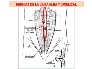 HERNIAS DE LA LÍNEA ALBA Y UMBILICAL
DIASTASIS
DE LOS
RECTOS
 
