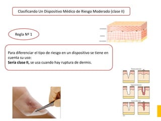 Clasificando Un Dispositivo Médico de Riesgo Moderado (clase II)
Regla Nº 1
Para diferenciar el tipo de riesgo en un dispositivo se tiene en
cuenta su uso:
Sería clase II, se usa cuando hay ruptura de dermis.
 