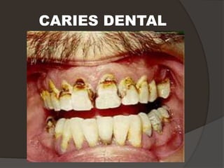 CARIES DENTAL
 