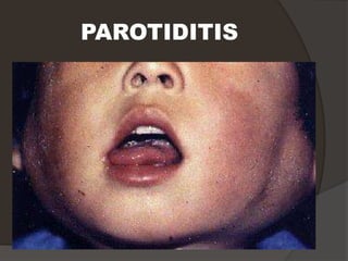 PAROTIDITIS
 