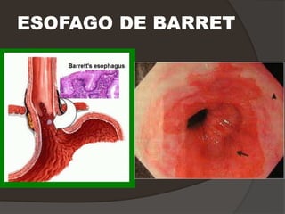 ESOFAGO DE BARRET
 