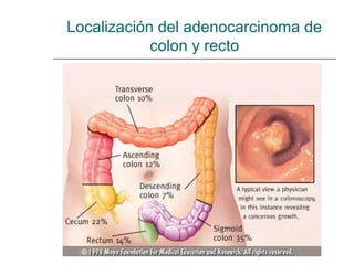 Localización del adenocarcinoma de
colon y recto
 