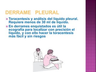  Toracentesis y análisis del líquido pleural. 
Requiere menos de 30 ml de líquido. 
 En derrames enquistados es útil la 
ecografía para localizar con precisión el 
líquido, y con ello hacer la toracentesis 
más fácil y sin riesgos 
 