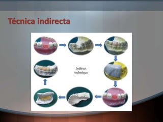 Técnica indirecta
 