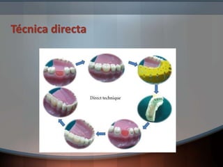 Técnica directa
 