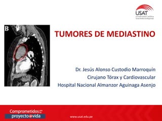 www.usat.edu.pe
www.usat.edu.pe
Dr. Jesús Alonso Custodio Marroquín
Cirujano Tórax y Cardiovascular
Hospital Nacional Almanzor Aguinaga Asenjo
TUMORES DE MEDIASTINO
 
