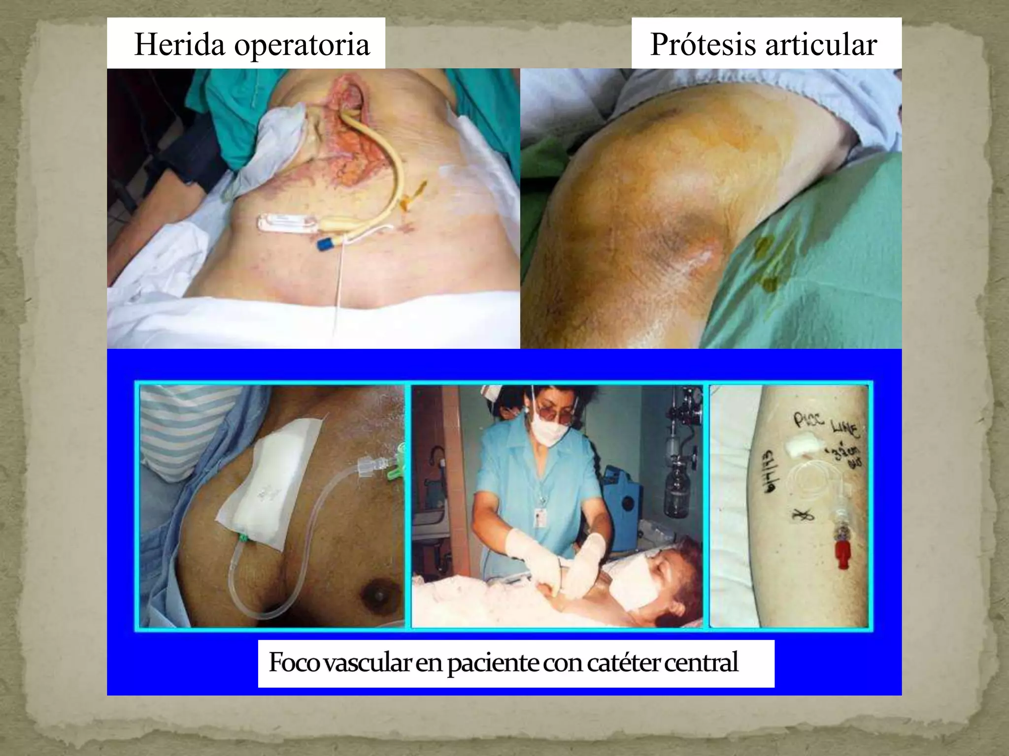 Herida operatoria   Prótesis articular
 