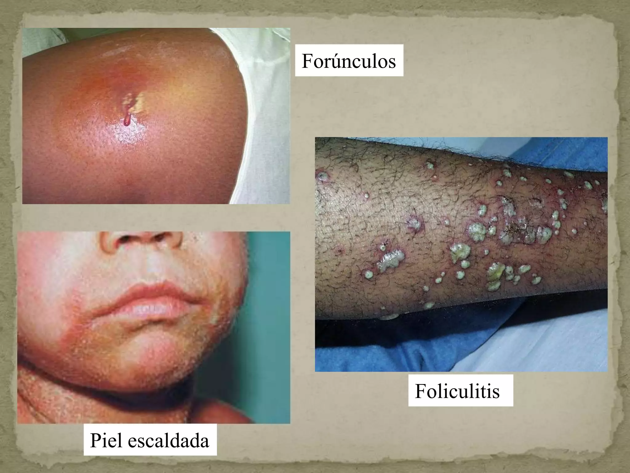 Forúnculos




                              Foliculitis

Piel escaldada
 