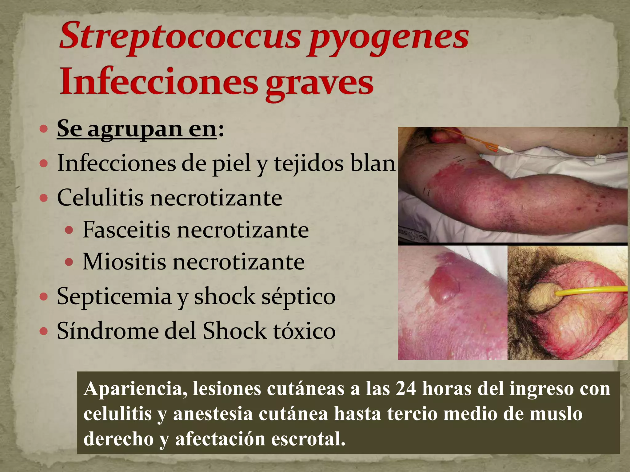  Se agrupan en:
 Infecciones de piel y tejidos blan.
 Celulitis necrotizante
   Fasceitis necrotizante
   Miositis necrotizante
 Septicemia y shock séptico
 Síndrome del Shock tóxico

    Apariencia, lesiones cutáneas a las 24 horas del ingreso con
    celulitis y anestesia cutánea hasta tercio medio de muslo
    derecho y afectación escrotal.
 