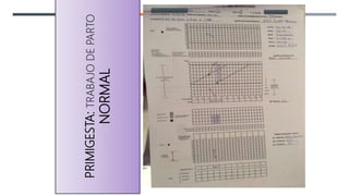 PRIMIGESTA:
TRABAJO
DE
PARTO
NORMAL
0
 