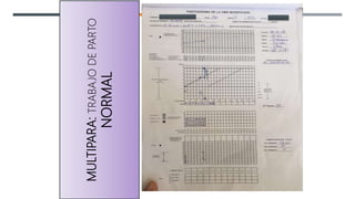 MULTIPARA:
TRABAJO
DE
PARTO
NORMAL
 